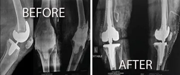 MoreEvidence_TotalKneeReplacement