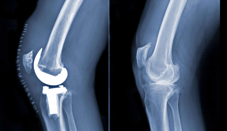 Knee Replacement X-Ray